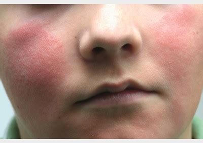 skin rashes treatment, News updates about skin rashes treatment 1 | News Track English, NewsTrack