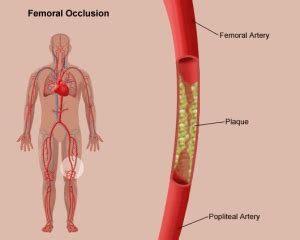 Femoral Popliteal Bypass | Stanford Health Care