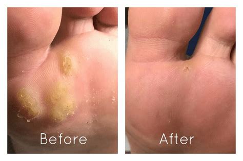 Plantar Warts Treatment NYC | Gotham Footcare Manhattan