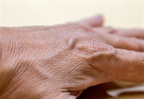 Causes and effective treatment of bulgy hand veins - Beauty Blog