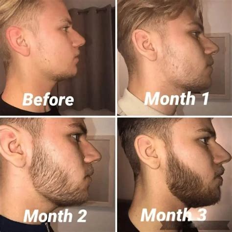 Beard Roller: Activate New Growth (Microneedle) - Bald & Beards