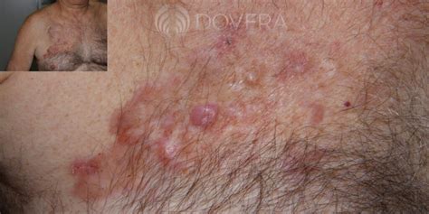 Dermatofibrosarcoma protuberans - Qual o melhor tratamento?