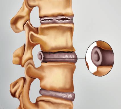 What is a bulging disc? | Spine & Orthopedic Center