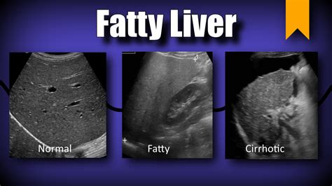 MEDICAL ULTRASOUND /FATTY LIVER