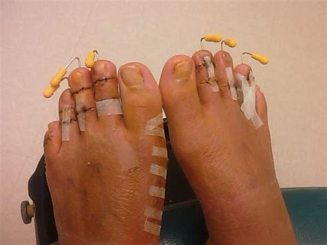 how old do you have to be to get toe shortening surgery