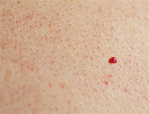 Pinpoint red dots on skin causes - tdfreeloads