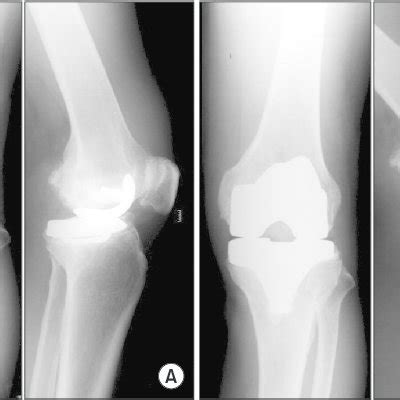 Examples of remodeling of the trochlear groove | Download Scientific ...