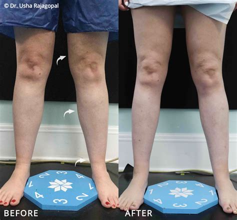 Ankle Liposuction | Usha Rajagopal, MD