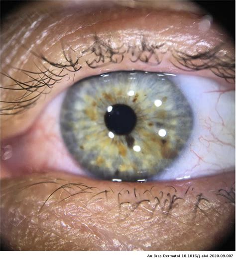 Dermoscopy of the iris: identification of Lisch nodules and contribution to the diagnosis of ...