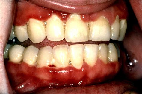 Necrotizing Periodontal Disease