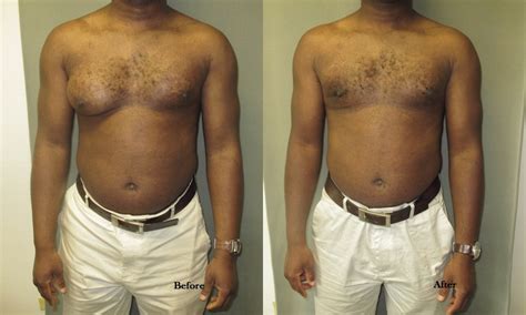 Gynecomastia - Causes, Symptoms, Diagnosis, Treatment, Surgery ...