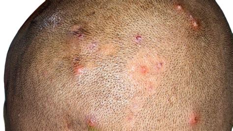 Scabs And Sores On Scalp Treatment Causes And Remedie - vrogue.co