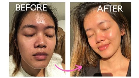 How I Get Rid of My Dehydrated Skin (ACNE JOURNEY in WINTER) - YouTube