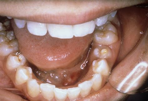 Blocked Salivary Gland Stones