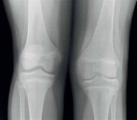 Osteoporosis Of Knee - Human Anatomy