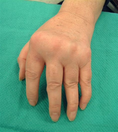 Hand Deformities Forearm Muscles Musculoskeletal Syst - vrogue.co