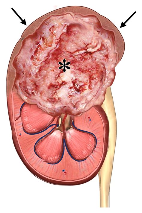 Urothelial Cancer of the Renal Pelvicaliceal System: Unusual Imaging Manifestations | RadioGraphics