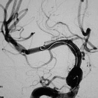 Vasospasm Treatment - Specialist Endovascular Services