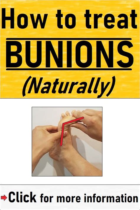 How to Treat Bunions (Naturally) in 2021 | Bunion exercises, Bunion ...