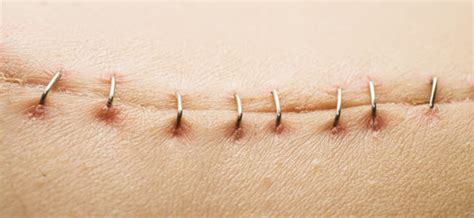 How To Take Care Of Surgical Staples | 7 Precautions To Take