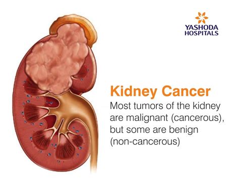 Tumors in Kidney | Kidney Cancer Causes, Symptoms, Diagnosis and Treatment