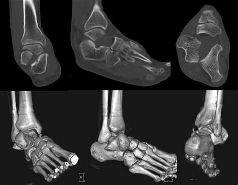 Coronal plane talar body fracture associated with subtalar and talonavicular dislocations: A ...