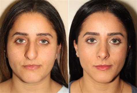 The Importance of Skin Thickness in Rhinoplasty - Dr. Denton