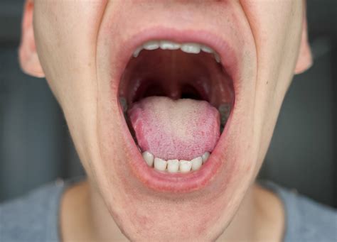 What should your tonsils look like? - Chloralieve