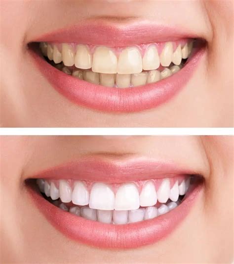 Brown Stains on Teeth? How to Remove Them Quickly - Dentaly.org