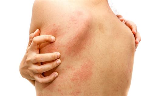 Acute Urticaria (Hives) - Utah Valley Dermatology