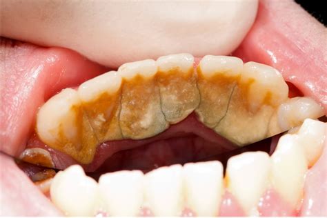 Plaque vs. Calculus | 209 NYC Dental