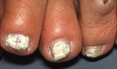 Onychomycosis (Tinea unguium, Nail fungal infection) - Dermatology Advisor