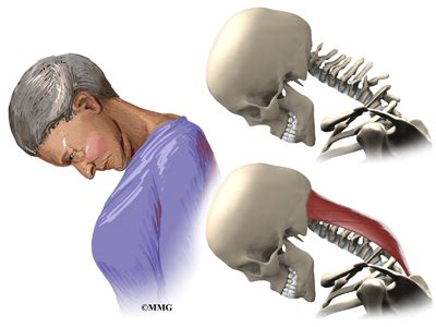 Dropped Head Syndrome | eOrthopod.com