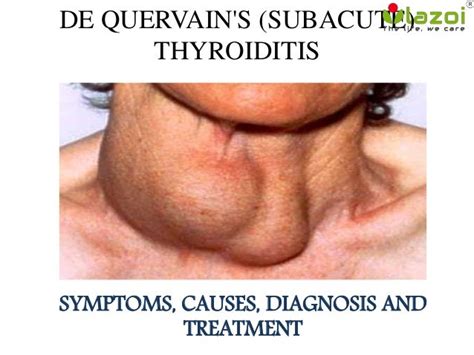 Thyroiditis