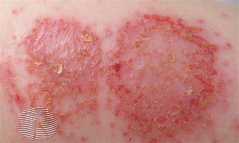 Discoid eczema | NHS inform