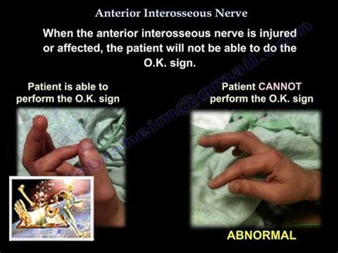 Anterior Interosseous Nerve - Everything You Need To Know - Dr. Nabil Ebraheim - YouTube