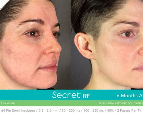 Secret RF | Radio Frequency Microneedling | Image Perfect Laser