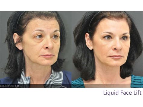 Liquid Face Lift I performed - Before & After pics | Facelift, Face, Botox