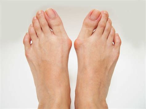 Bunions: Causes, Symptoms and Treatment | Sanders Podiatry Clinics