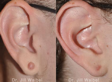 Keloid Treatment Ear And Earlobe Scottsdale Phoenix Arizona | lupon.gov.ph