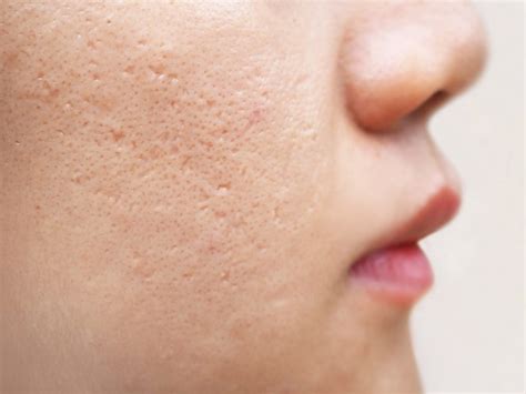 Ice Pick Acne Scars | Trusted Aesthetic Clinic