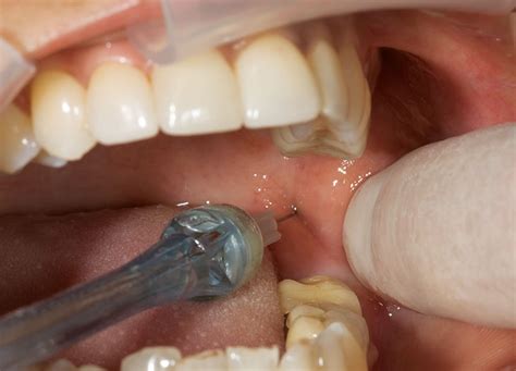 Inferior Alveolar Nerve Block Dental