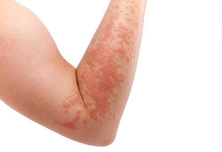 Hives - Common Causes & More - HonorHealth