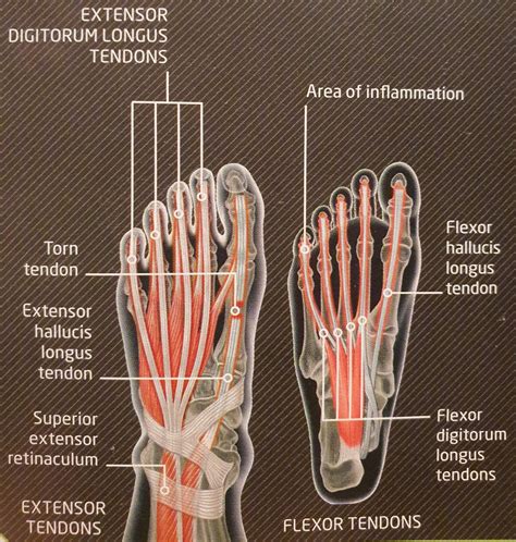 tendon injuries in foot and ankle - Massage Kildare Naas Portlaoise