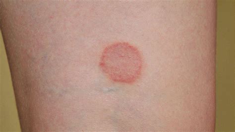 Pityriasis Rosea: Stages, Causes & Treatment - Health Blog