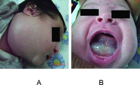 Impending Airway Compromise due to Cystic Hygroma - The Western Journal of Emergency Medicine