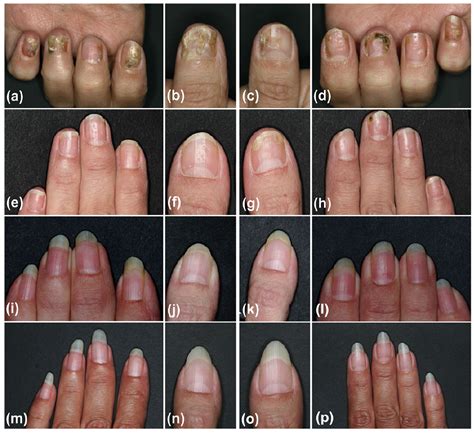 Efficacy of Adalimumab for Nail Psoriasis During 24 Months of Continuous Therapy | HTML | Acta ...