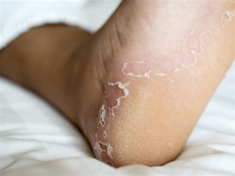 What Causes Itchy Feet? 4 Common Causes - JAWS podiatry