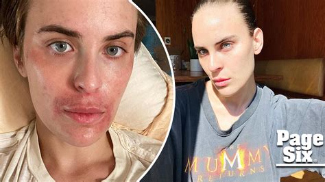 Tallulah Willis shares before-and-after photos of skin transformation