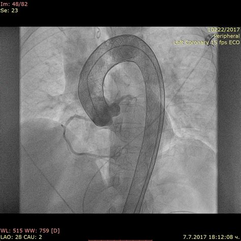 Endovascular Treatment of Type A Aortic Dissection